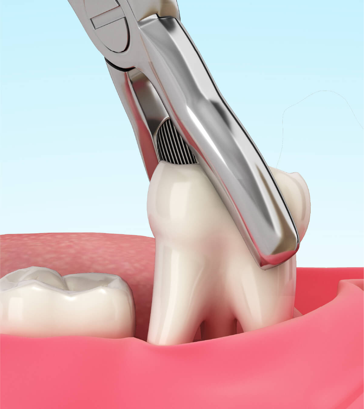 What Are Dental Crowns?